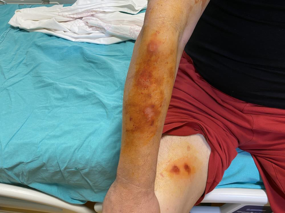 Lavabo açıcı kullanırken meydana gelen kimyasal reaksiyonlar, çok ciddi yanıklara