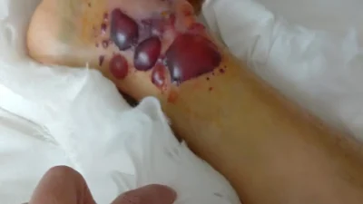 Kocaeli Devlet Hastanesi ortopedi servisinde tedavi gören bir hastanın, hatalı