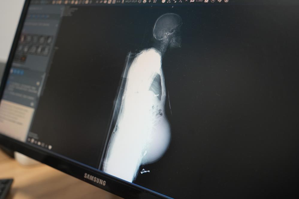 Kocaeli'de doktorları şaşırtan olay: Tam 6,5 kilogram geldi!