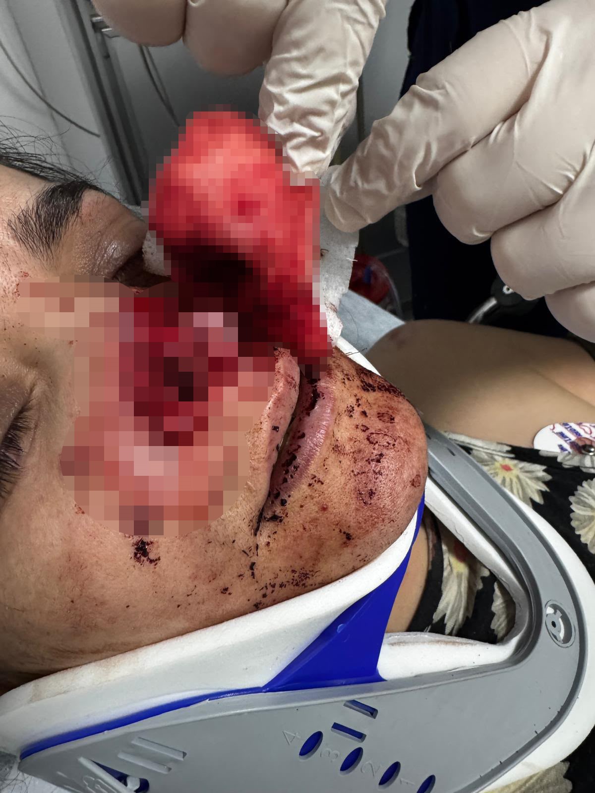 Koca dehşeti: Eşinin burnunu ısırıp kopardı